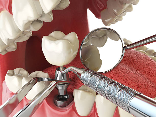 Best Emergency Dentist for Lost Fillings or Crowns in Watervliet, NY